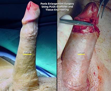 Cock Enlargement Surgery 21