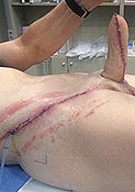 Neophallus donor site scar