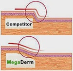 Enhancement of graft for penis enhancement surgery should improve aesthetics of phalloplasty