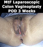 M2F Laparoscopic Colon Vaginoplasty