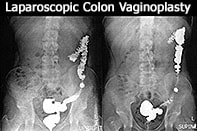 Laparoscopic Colon Vaginoplasty