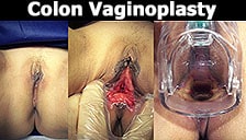 MtF Colon Vaginoplasty