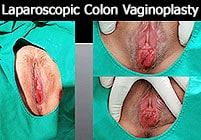 M2F Vaginoplasty