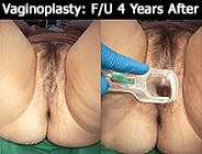 Penile Skin Inversion Vaginoplasty