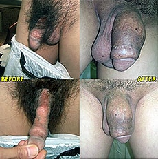 MegaFill penis enlargement: before and after