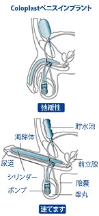 最新技術の補綴インフレータブル陰茎は　最高の　勃起不全治療だ