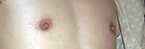 Extended Keyhole FtM Mastectomy