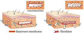 Improved processing aims to improve vascularization of phalloplasty graft