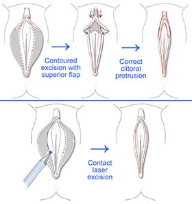 Labiaplasty