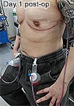 Non-binary top surgery