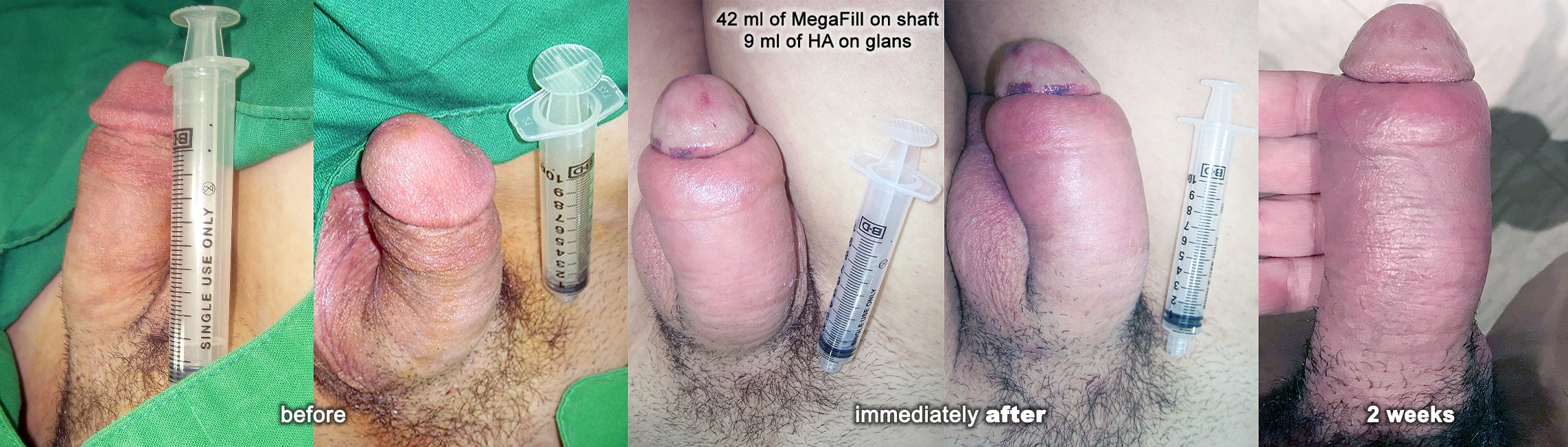 Where do porn stars get penis enlargement