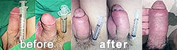 Penis enlargement before and after photos