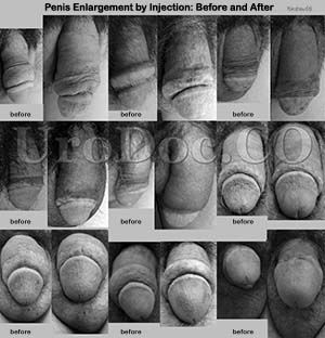 Penis Enlargement by Injection: Before and After