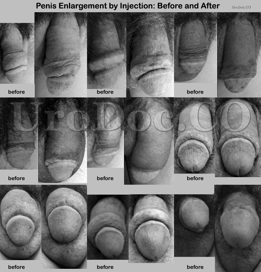 PMMA Injections for Buttock Augmentation Side Effects ...