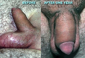 Ultimate Penis Enlargement using MegaFill