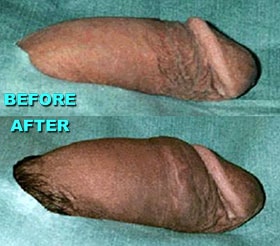 Penis enlargement by injection of MegaFill: before and after photo