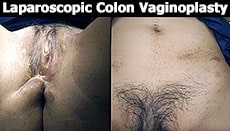 MtF Surgery Vaginoplasty